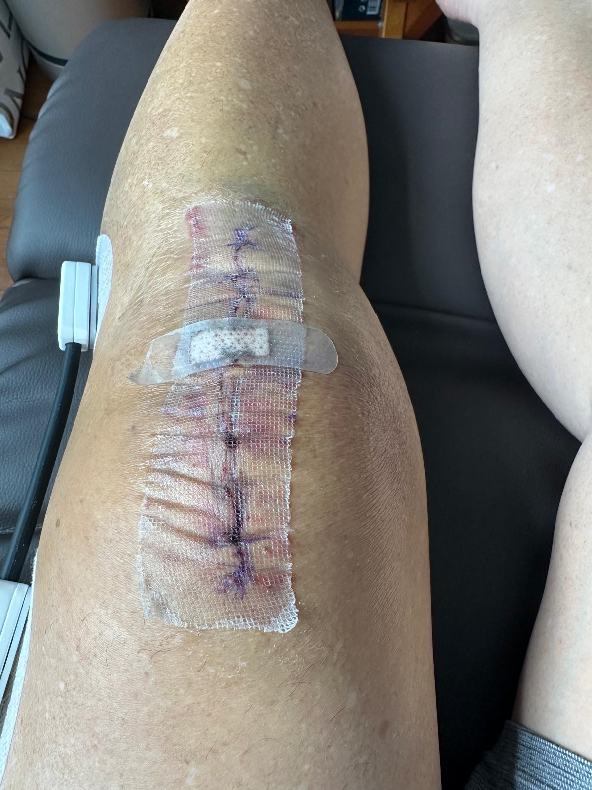 Post-operative knee on day 1 of recovery