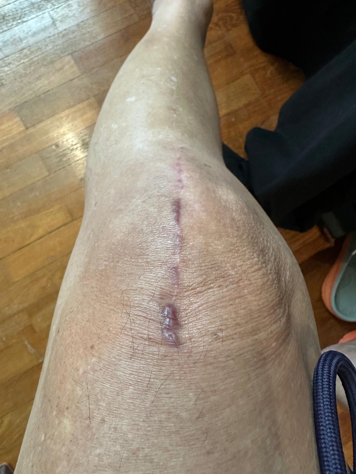 The same knee on day 20, scar healing